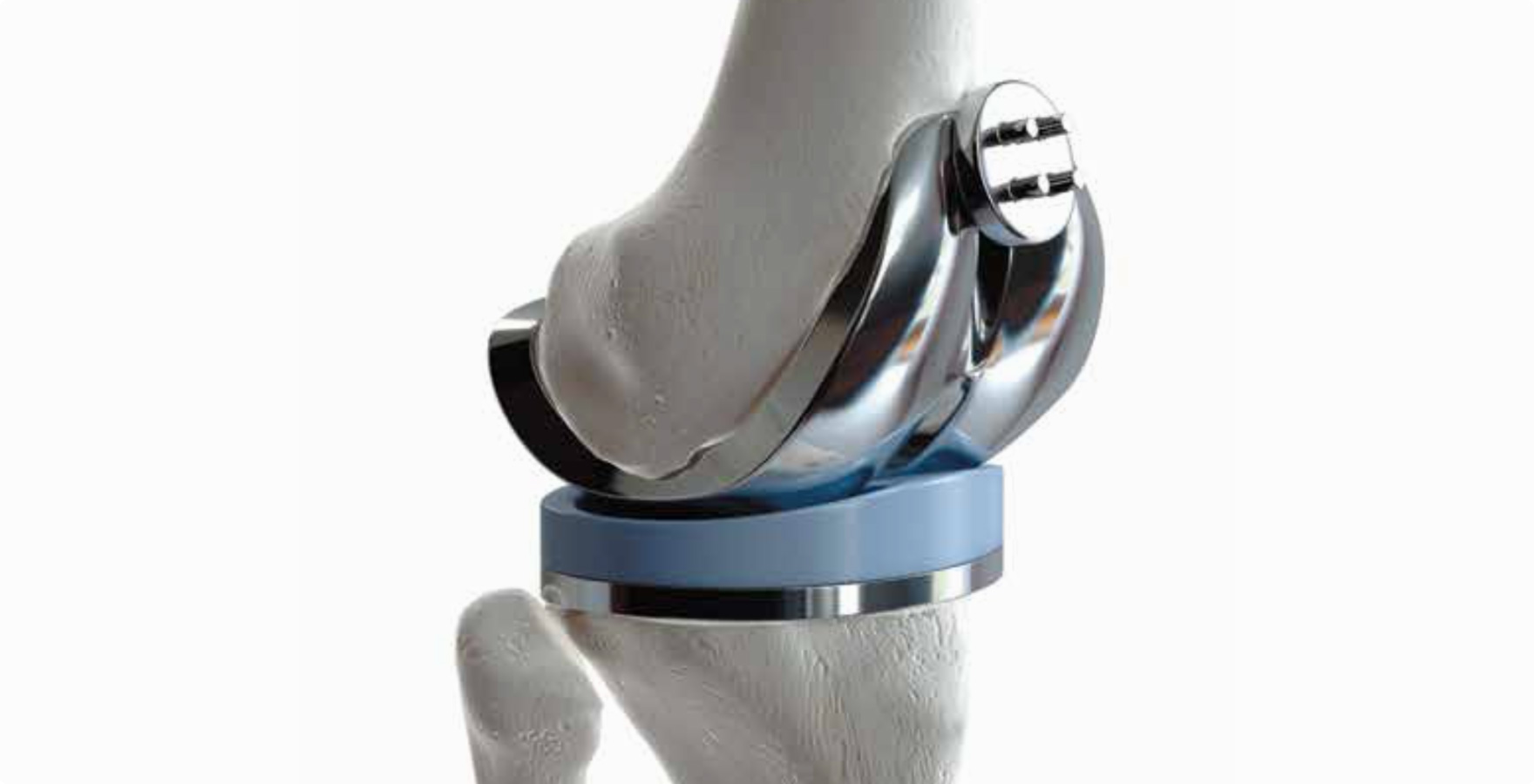 Image of artificial knee joints